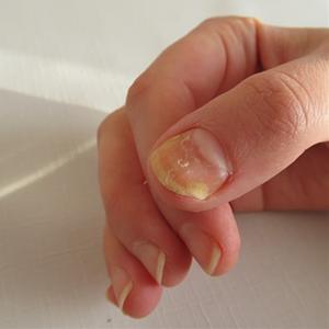 손발톱 진균 감염의 원인과 치료:   야생버섯의 신비(192)